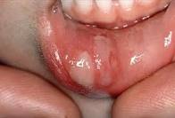 canker sores in mouth